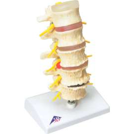 3B Anatomical Model - Vertebrae Degeneration, Stages of Prolapsed Disc