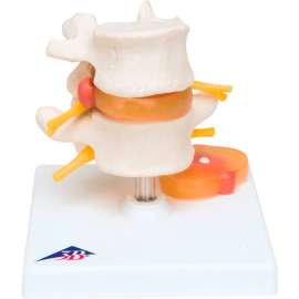 3B Anatomical Model - Lumbar Spinal Column with Prolapsed Intervertebral Disc