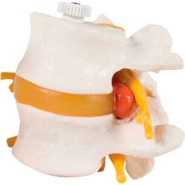 3B Anatomical Model - 2 Lumbar Vertebrae with Prolapsed Disc, Flexibly Mounted