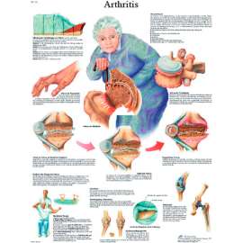 3B Anatomical Chart - Arthritis, Paper