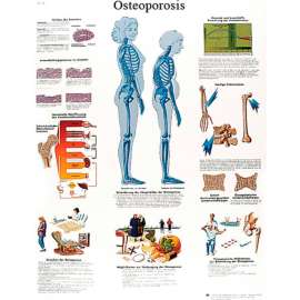 3B Anatomical Chart - Osteoporosis, Laminated