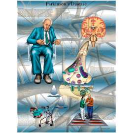 3B Anatomical Chart - Parkinson's Disease, Laminated