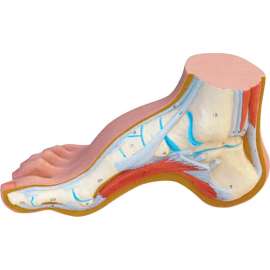 3B Anatomical Model - Hollow Foot (Pes Cavus)